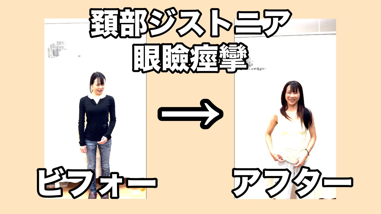 痙性斜頸　眼瞼痙攣　食いしばり　女性
